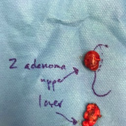 Parathyroid adenoma removal Canberra