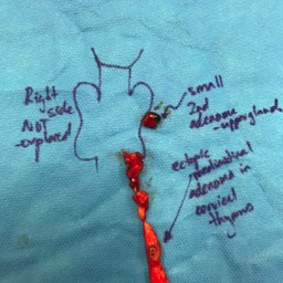 Parathyroid adenoma removal Canberra