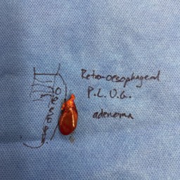 Parathyroid adenoma removal Canberra