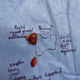 Parathyroid adenoma removal Canberra