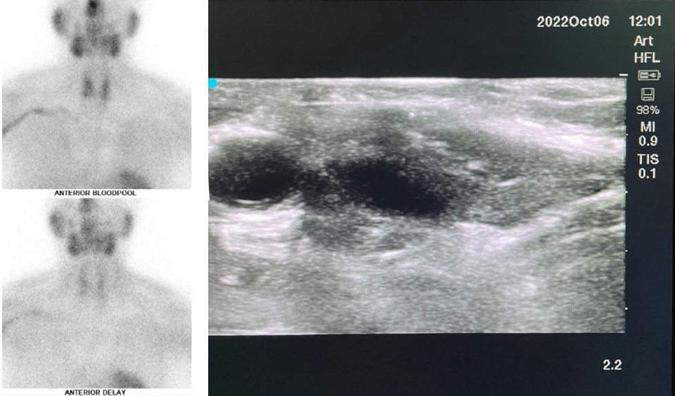 SestaMIBI scan and intraoperative ultrasound are used in the investigation of parathyroid adenomas 