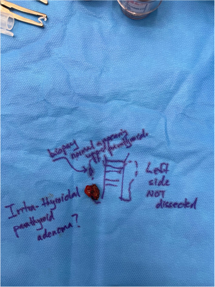 Photo taken in theatre showing successful removal of parathyroid adenoma located inside thyroid gland - uncommon but well known occuring 1% of the time.