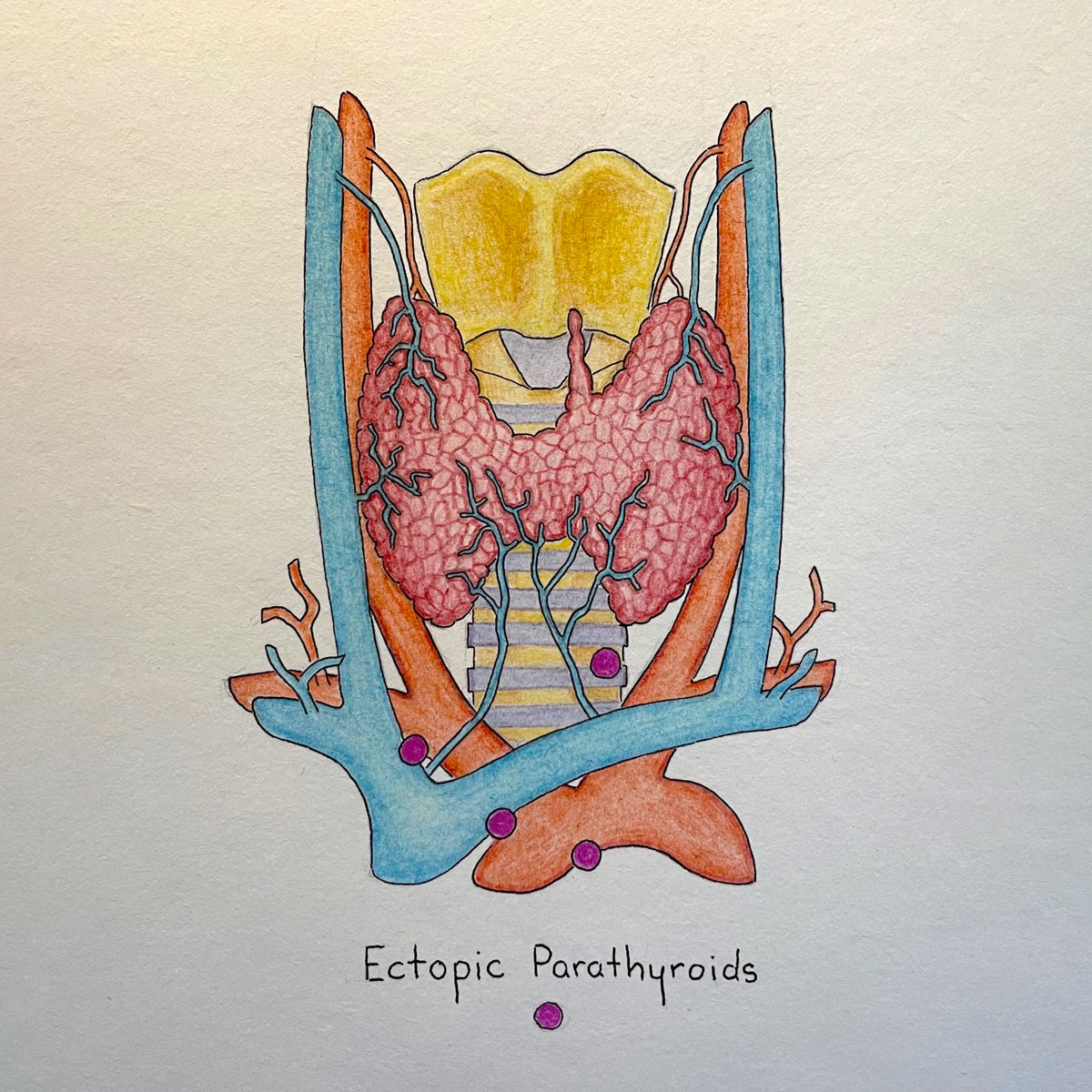 Colour anatomical illustration showing location of ectopic parathyroids