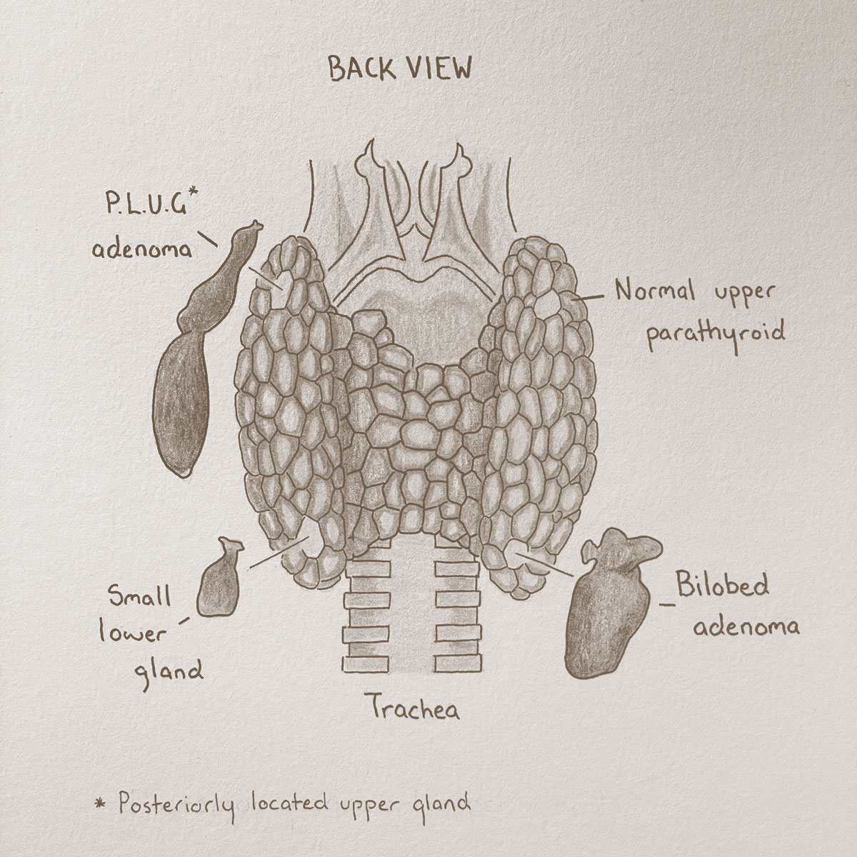 Sepia anatomical illustration back view of thyroid adenoma