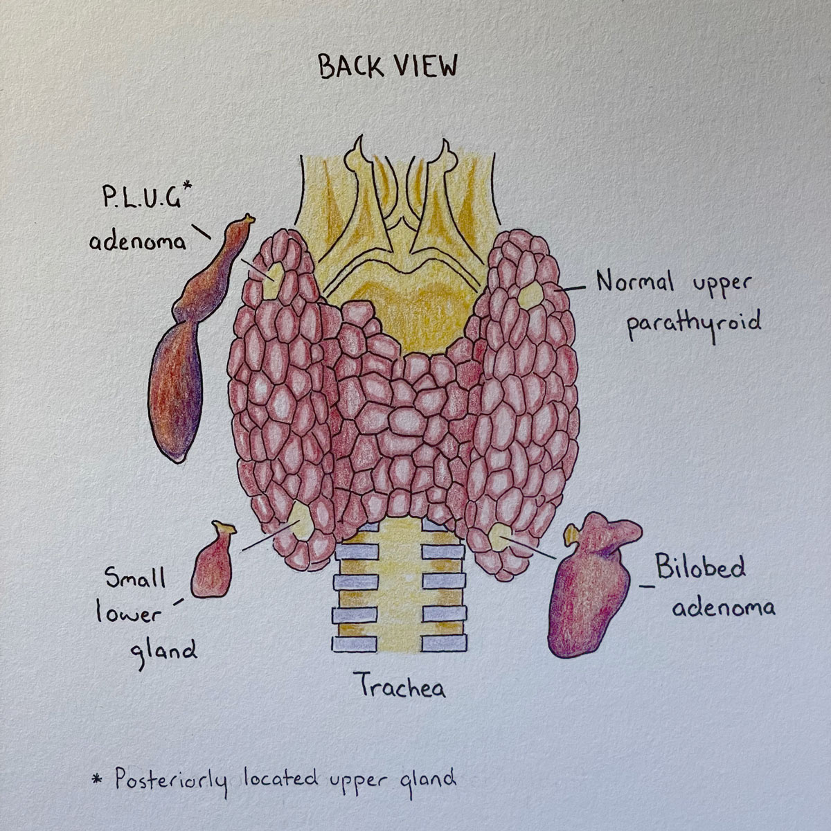 Colour anatomical illustration back view of thyroid adenoma